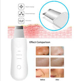 ultrazvučni aprat za čišćenje lica - ultrazvučni aprat za čišćenje lica