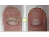 Tretman protiv gljivica na noktima gljivične infekcije nokta - Tretman protiv gljivica na noktima gljivične infekcije nokta